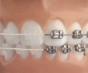 Ortodonzia tradizionale con attacchi in metallo o in ceramica bianca
